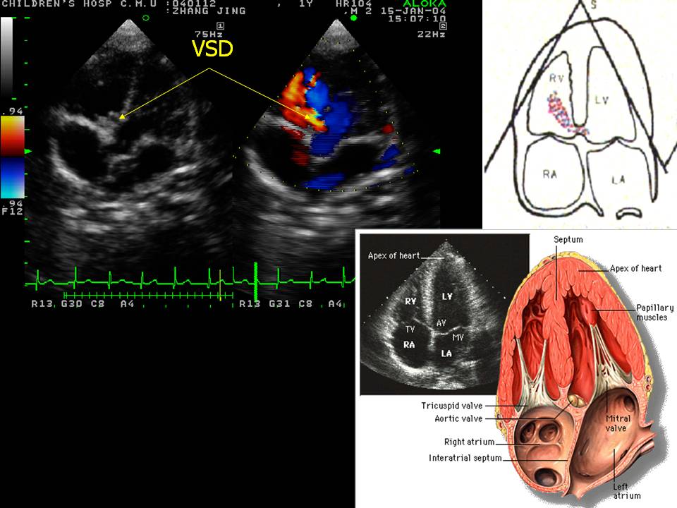 室间隔缺损超声图解图片
